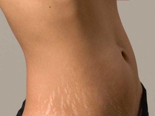 stretch marks