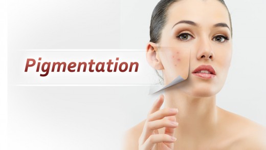 Get rid of pigmentation naturally